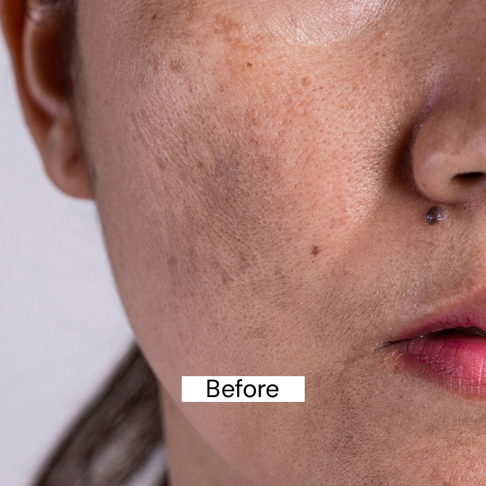Before use Pigmentation Cream