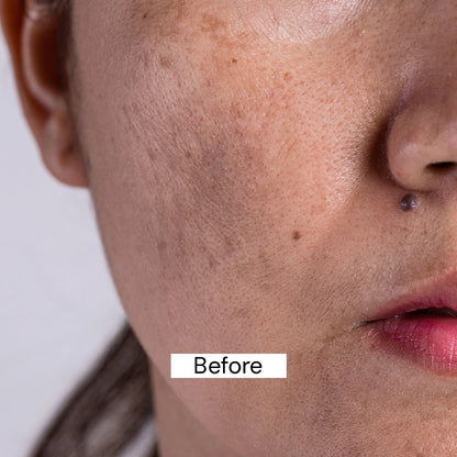 Before use Pigmentation Cream 